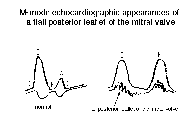M-mode echocardiographic waveforms comparing a normal mitral valve and a flail posterior leaflet of the mitral valve, with labeled wave peaks.