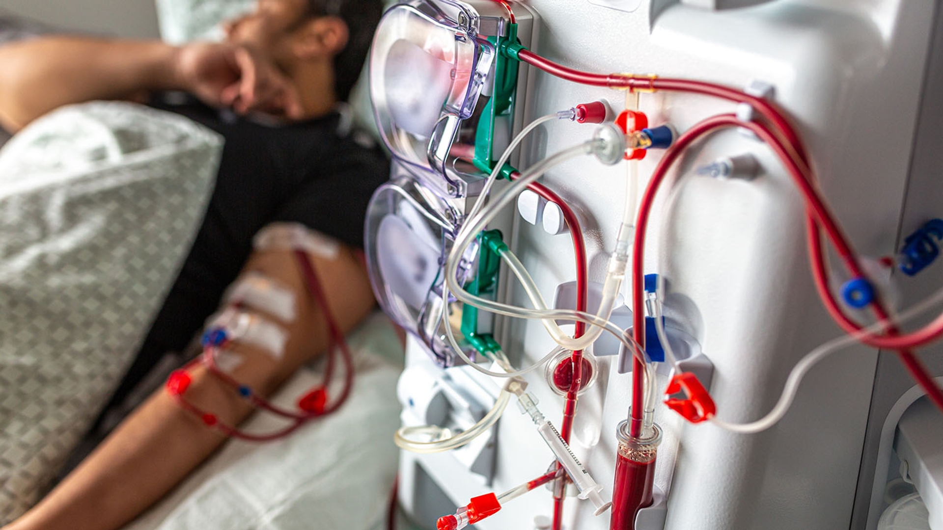 A patient's arm connected to a hemodialysis machine, with blood visible in the tubing.