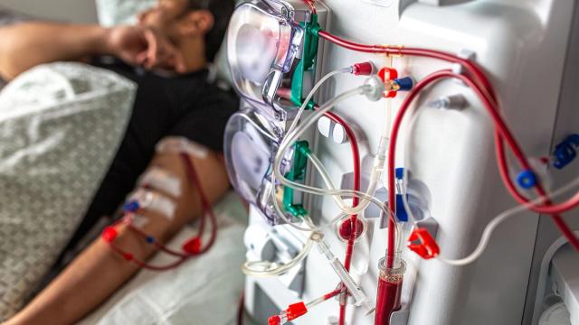 A patient's arm connected to a hemodialysis machine, with blood visible in the tubing.
