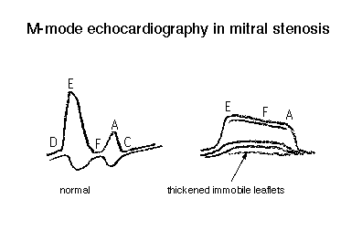 Comparison of M-mode echocardiography graphs showing normal heart valve motion versus thickened immobile leaflets in mitral stenosis.