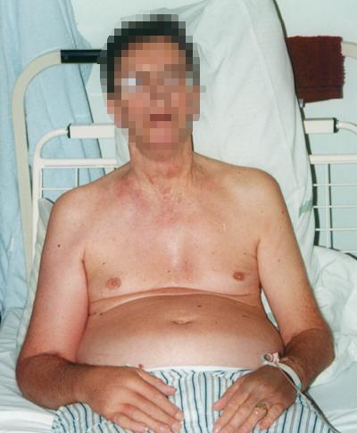 Man sitting in a hospital bed, shirtless, with an IV in his arm and wearing striped hospital pants.