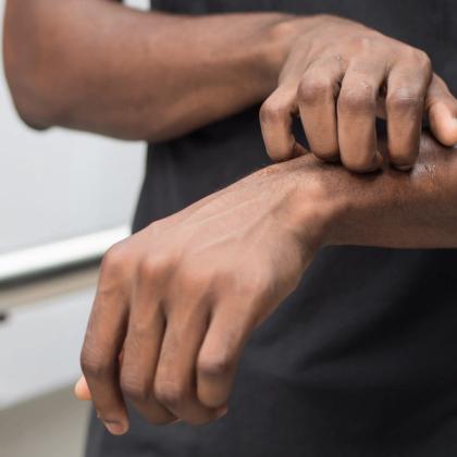Close-up of a person scratching an itchy wrist, showing details of hands and fingers.