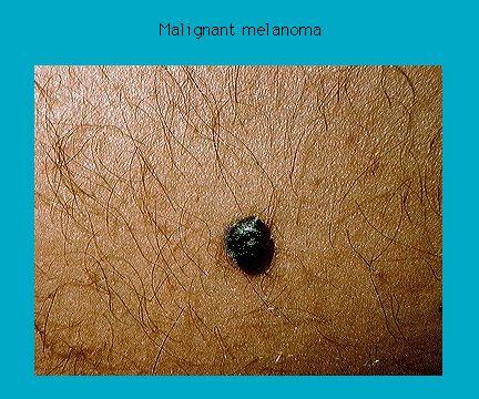 Close-up of a malignant melanoma on human skin, showing a dark, irregular mole surrounded by lightly haired skin.