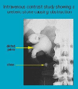 X-ray image from intravenous contrast study showing a ureteric stone causing obstruction with labeled areas indicating dilated pelvis and stone locations.