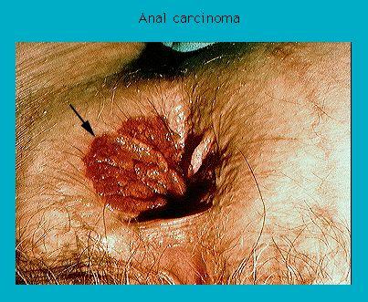 Medical image showing a case of anal carcinoma with visible tumor