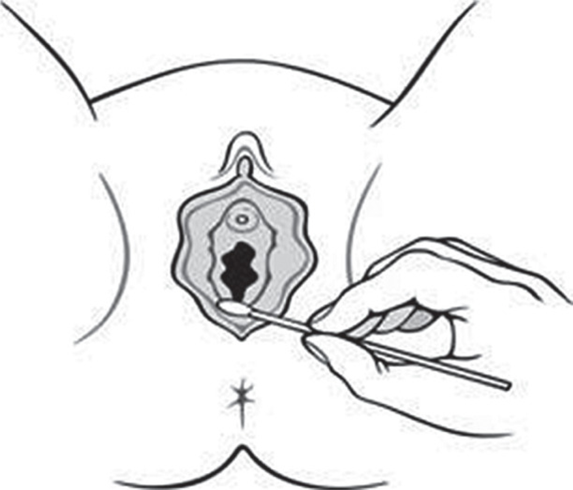 Cotton swab testing in vulvodynia