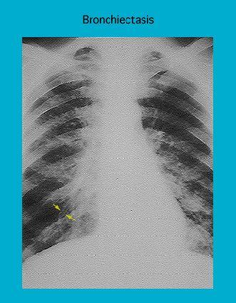 X-ray image showing bronchiectasis condition with visible markings on the left lung