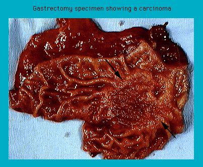 Gastrectomy specimen showing a carcinoma on a blue background