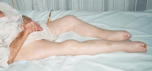Baby lying on a bed with visible bruising on legs and a medical IV in the arm.