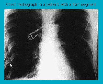 Chest X-ray showing a flail chest segment with visible surgical staples and medical annotations