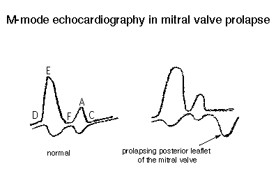 Diagram illustrating M-mode echocardiography waves for normal mitral valve and prolapsing posterior leaflet of the mitral valve in mitral valve prolapse with labels.