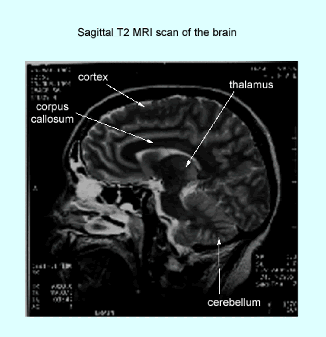 MRI brain scan (sagittal section) – GPnotebook