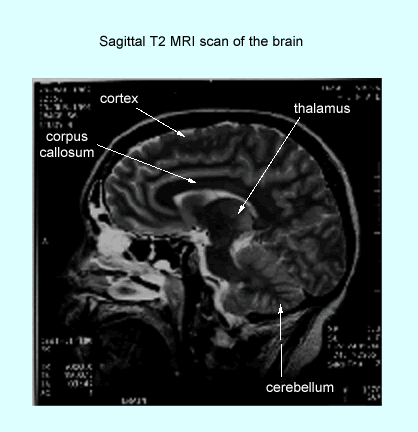 Sagittal T2 MRI scan of the human brain highlighting the cortex, thalamus, corpus callosum, and cerebellum.