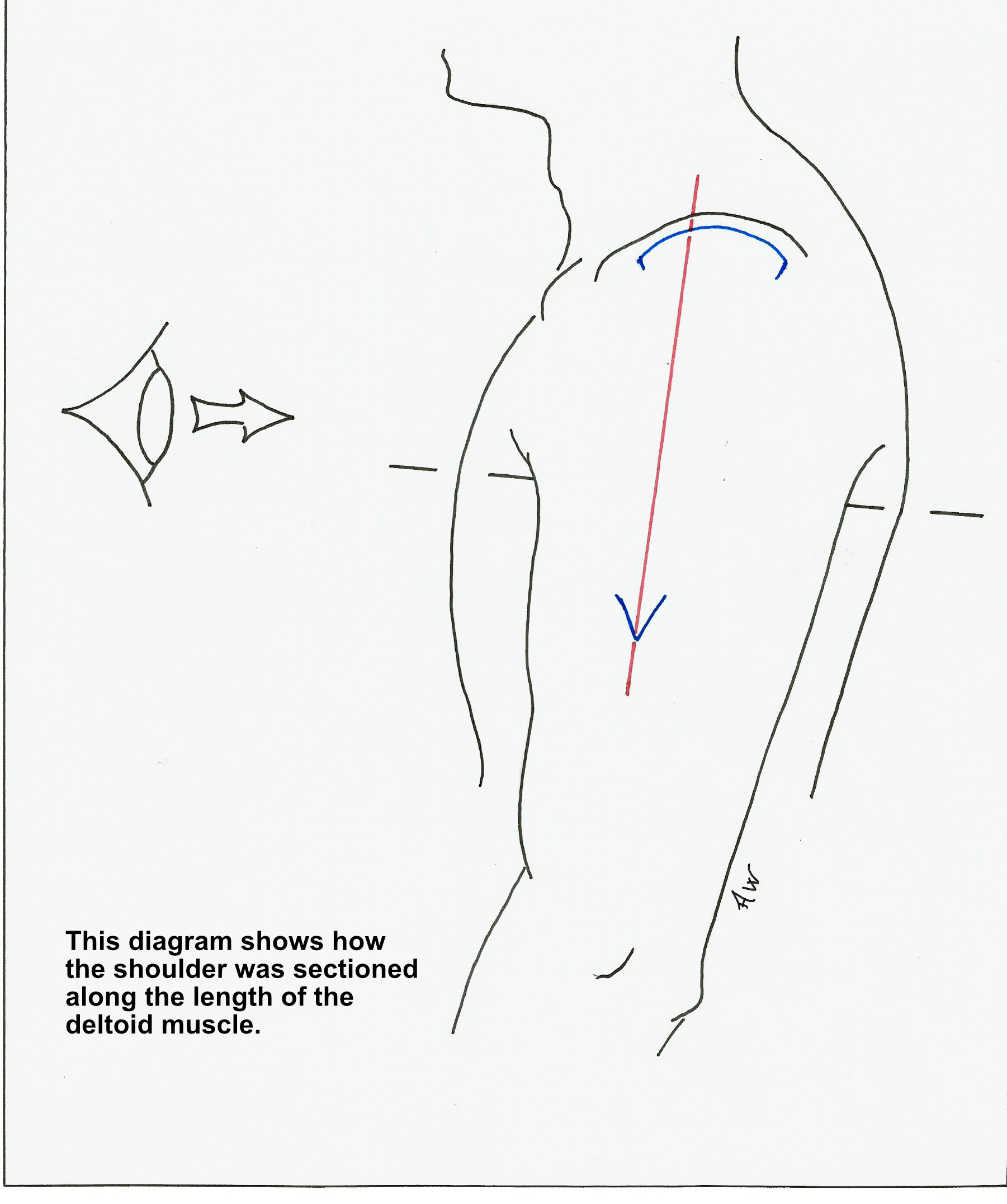 Diagram illustrating the sectioning of the shoulder along the deltoid muscle with directional arrows indicating movement.