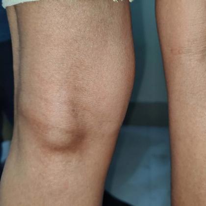 Close-up of a human elbow showing skin texture and natural folds