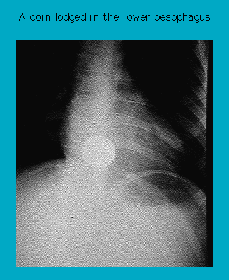 X-ray image showing a coin lodged in the lower esophagus