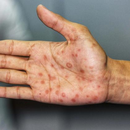 Close-up of a human hand showing signs of a skin condition with multiple red spots and a single prominent blister on the palm.