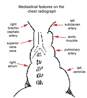 Diagram showing mediastinal features on a chest radiograph with labeled parts including the superior vena cava, right atrium, left ventricle, pulmonary artery, aortic knuckle, left subclavian artery, and right brachiocephalic artery.