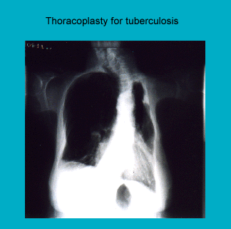 X-ray image showing thoracoplasty treatment for tuberculosis