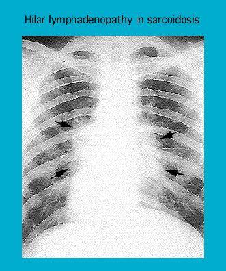 X-ray image showing hilar lymphadenopathy typical of sarcoidosis with distinct markings indicating affected areas