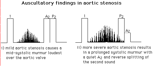 Graphical representation of auscultatory findings in aortic stenosis comparing mild and severe conditions, illustrating sound wave patterns and heart sound markings for educational purposes.
