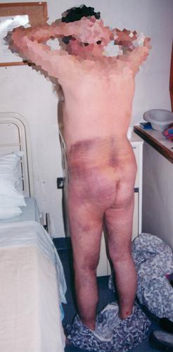 Back view of a person with severe bruising on lower back and legs, standing in a room wearing slippers