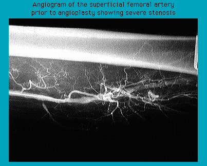 Angiogram of the superficial femoral artery showing severe stenosis before angioplasty treatment