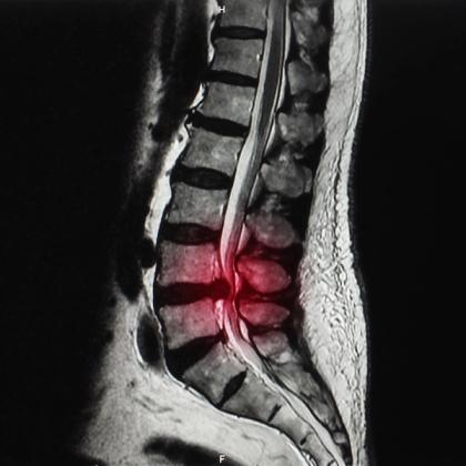 MRI scan showing a lumbar spinal disc herniation with highlighted affected area in red.