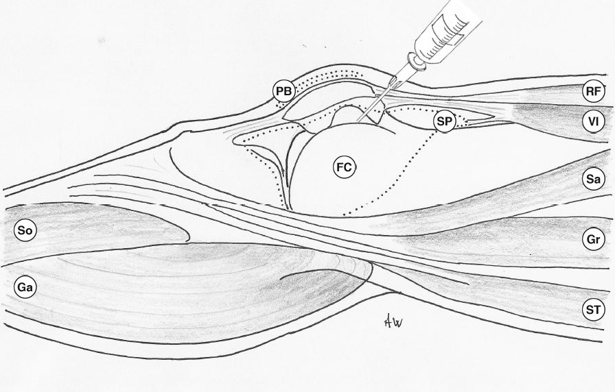 Left Knee Injection Medial approach - aspiration or injection of the knee joint – Primary ...