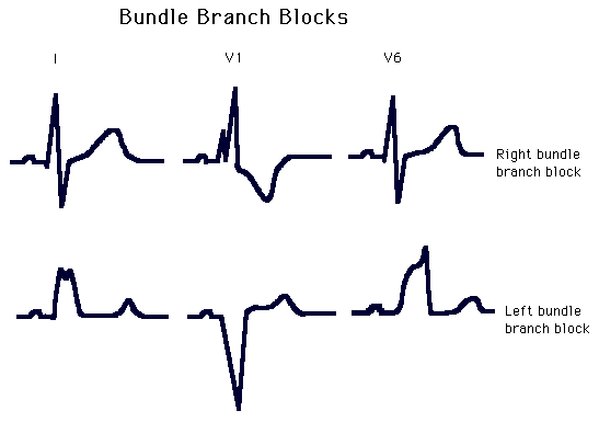 Diagram illustrating electrocardiogram (ECG) waveforms for right and left bundle branch blocks in leads I, V1, and V6.