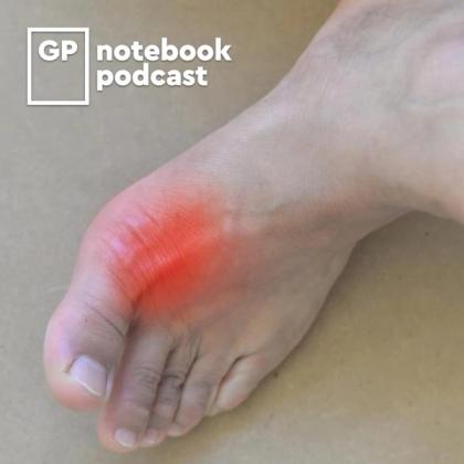 Close-up of a human foot with red inflammation on the side, featuring the GP Notebook podcast logo in the upper left corner.