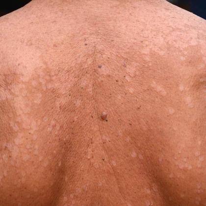 Person's back with numerous hypopigmented patches and several moles.