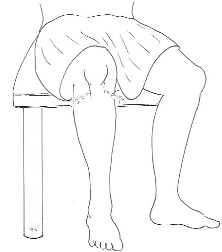 Anterior approach aspiration or injection of the knee joint GPnotebook