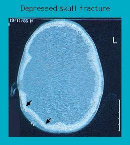 X-ray image showing a depressed skull fracture with marked areas indicated by arrows