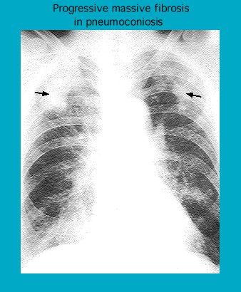 X-ray image showing advanced stage of progressive massive fibrosis in pneumoconiosis, with marked lung scarring indicated by arrows.