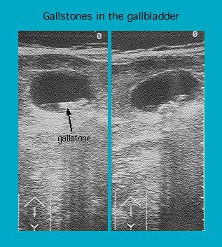 Ultrasound images showing gallstones in the gallbladder, with marked indications of a gallstone in the left panel.