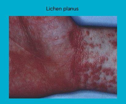 Close-up image of skin affected by Lichen Planus showing red, inflamed patches and lacy white spots