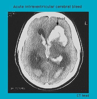 CT head scan showing acute intraventricular cerebral bleed with visible blood accumulation