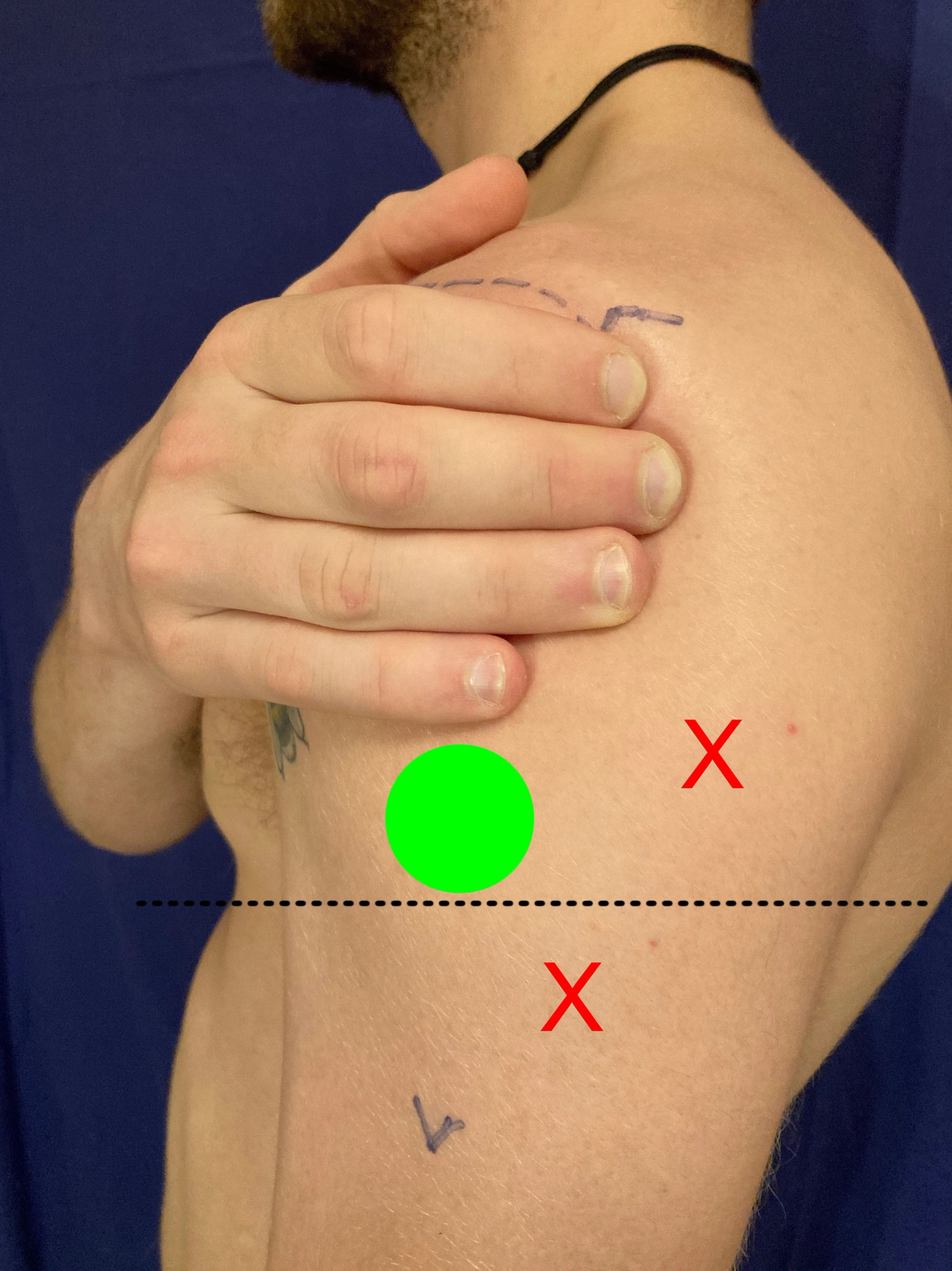 Close-up of a tattooed man's shoulder showing surgical scars, with a hand covering part of the area; green and red marks indicate points of interest.