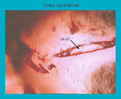Close-up of a scalp laceration showing exposed skull and blood.