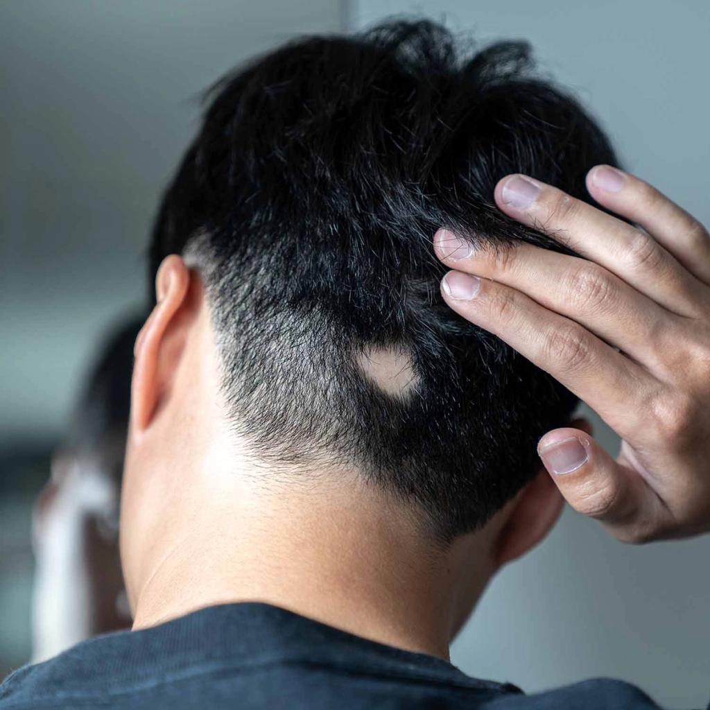 Back of a head with a round bald spot and a hand touching the hair.
