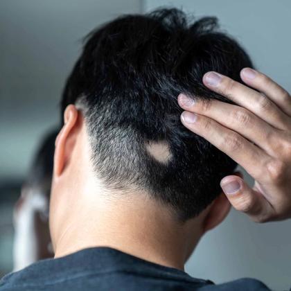 Back of a head with a round bald spot and a hand touching the hair.