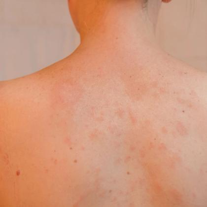 Close-up of a person's back covered in red, raised skin rash or hives.
