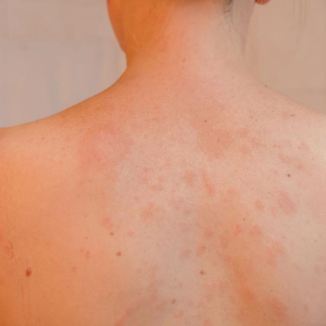 Close-up of a person's back covered in red, raised skin rash or hives.