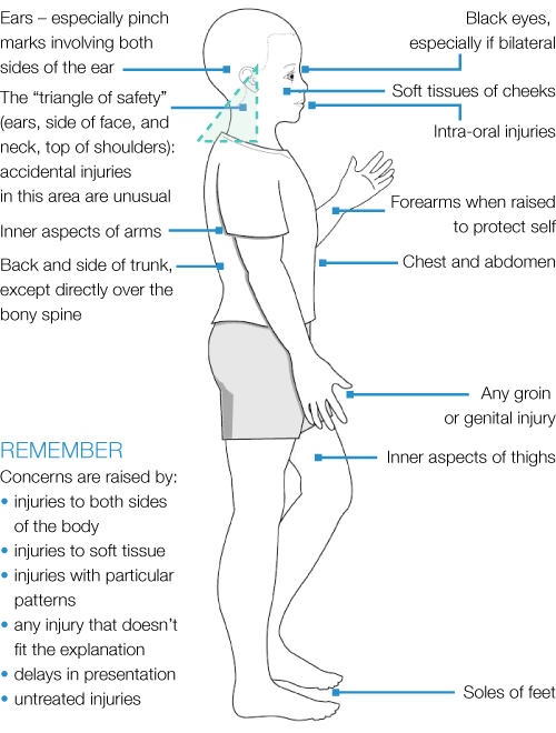 Non Incapacitating Injury Typical features of non-accidental injuries in children (injuries that ...