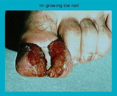 Close-up of a severe case of ingrown toenails on infected toes with text label 'In-growing toe nail'