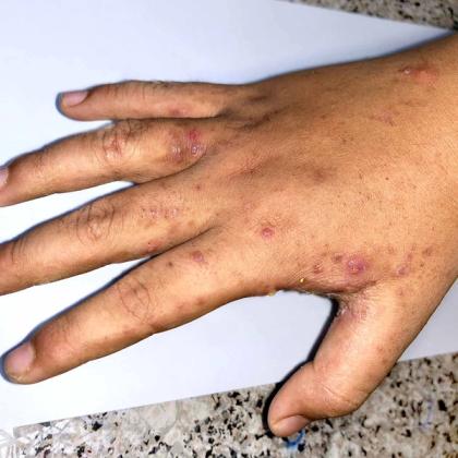 Close-up of a hand showing symptoms of a skin condition with red spots and blisters on a white background.