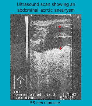 Ultrasound image showing an abdominal aortic aneurysm with red markers indicating the area of interest and annotations describing the 55 mm diameter.