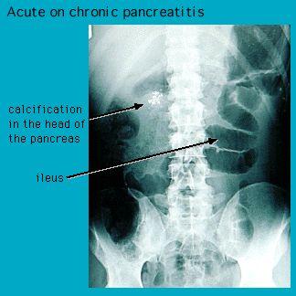 X-ray image showing acute on chronic pancreatitis with annotations pointing to calcification in the head of the pancreas and ileus