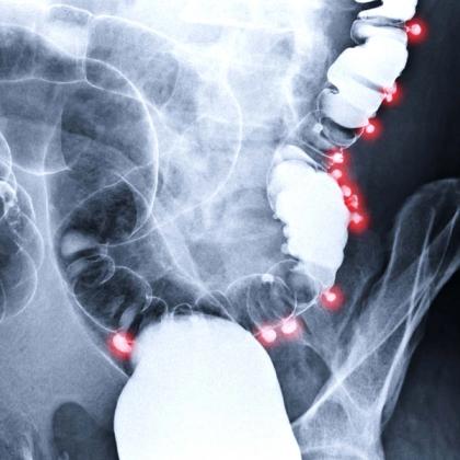 X-ray image of a human colon showing highlighted areas indicating possible medical issues or abnormalities.